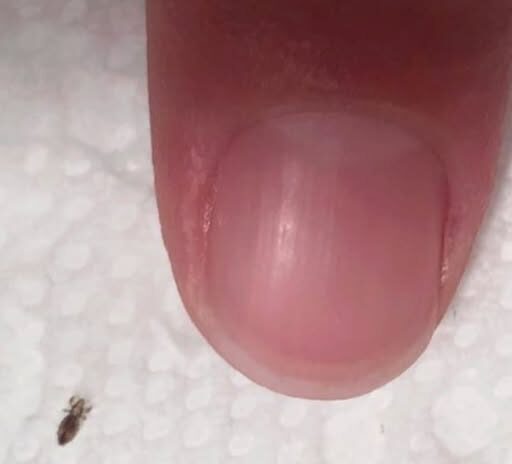 Found a Tiny Bug in Your Hair? Read This First